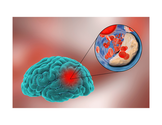 Cerebral Small Vessel Disease (CSVD) | More Common Than You Think!